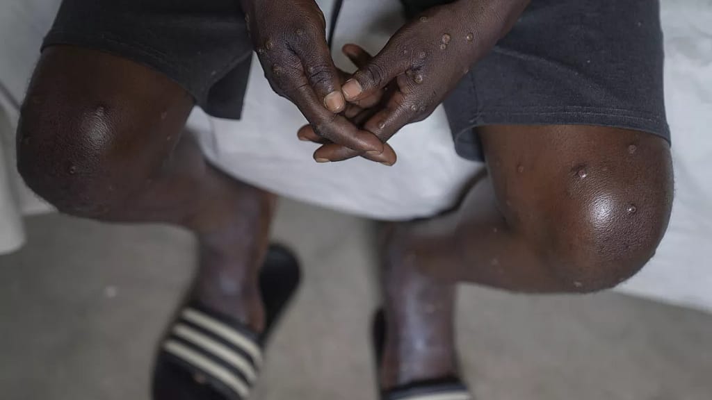 Nigerian Medical Association Urges Cross River to Bolster Mpox Surveillance