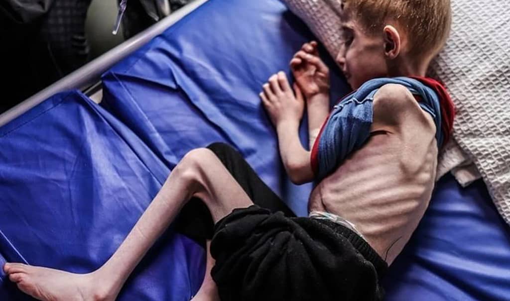 Malnutrition in Gaza Reaches Alarming Heights