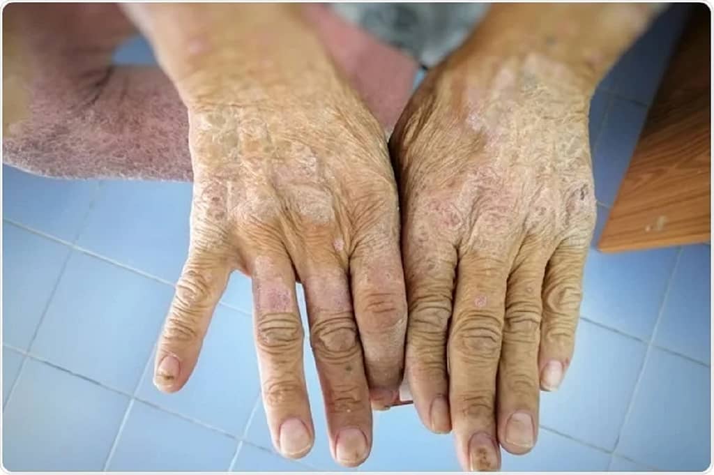 Living with Scleroderma is not a Death Sentence